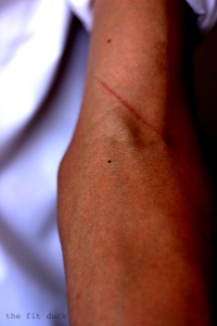 Scar on my arm